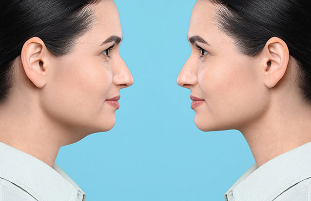 Woman's results from double chin reduction in Bay Area