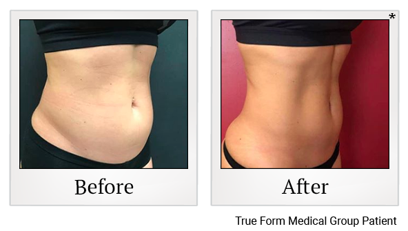 Results of Emsculpt treatment at True Form Medical Group in Oakland and Fremont