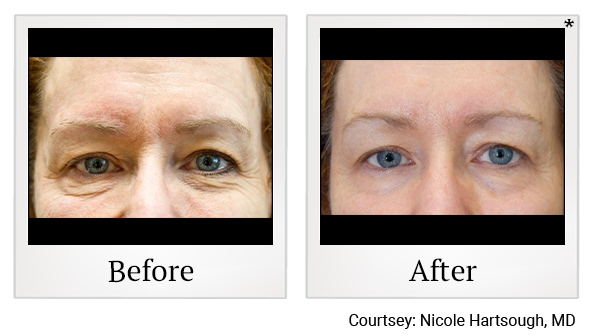 Results of Exilis Ultra treatment at True Form Medical Group in Oakland and Fremont