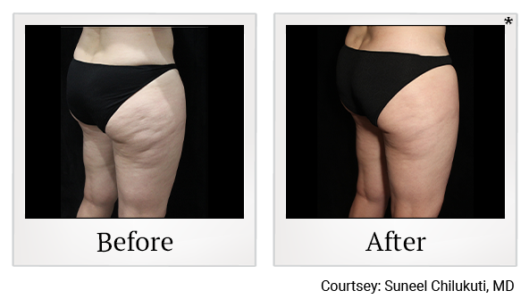 Exilis results 2 at Bay Area Med Spas in Oakland and Fremont