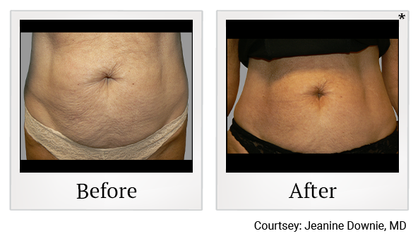 Exilis results 1 at Bay Area Med Spas in Oakland and Fremont