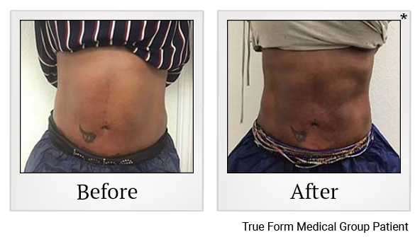 Results 3 of exilis ultra treatment at Bay Area Med Spas in Oakland and Fremont