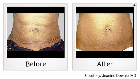Results of Exilis Ultra treatment at True Form Medical Group in Oakland and Fremont