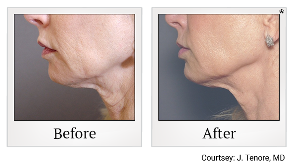 Results of Exilis Ultra treatment at True Form Medical Group in Oakland and Fremont