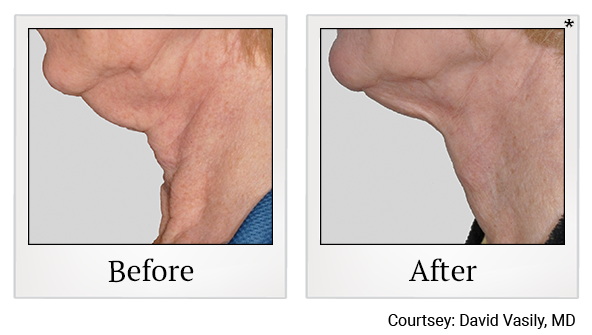 Results of Exilis Ultra treatment at True Form Medical Group in Oakland and Fremont