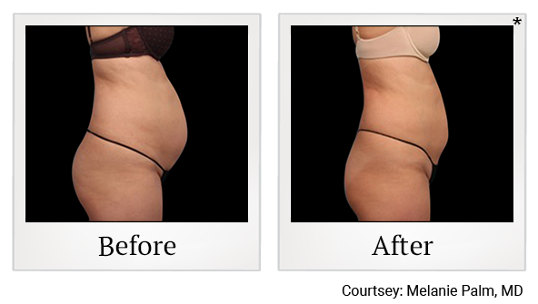 Results of Vanquish ME treatment at True Form Medical Group in Oakland and Fremont