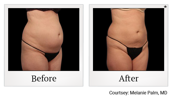 Results of Vanquish ME treatment at True Form Medical Group in Oakland and Fremont
